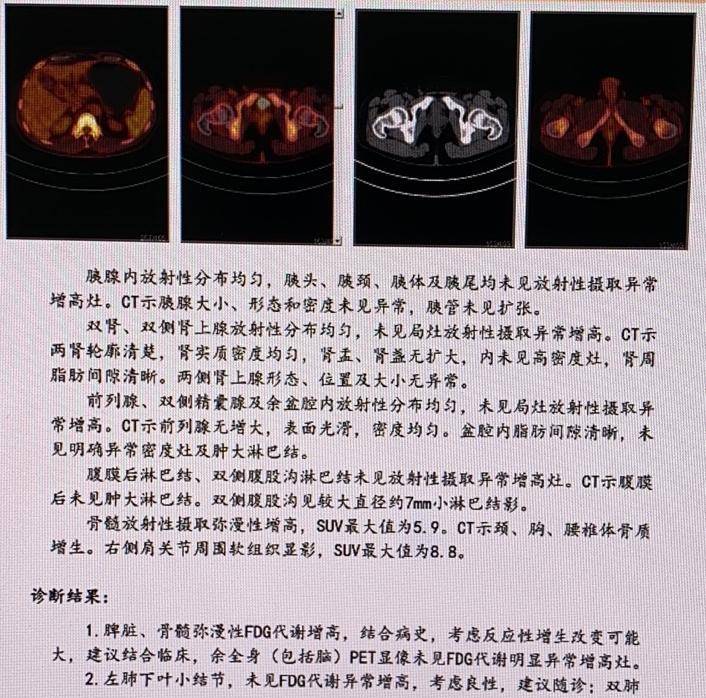 脾脏骨髓弥漫性FDG代谢增高做PETCT检查